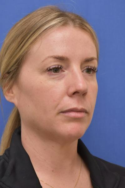 Facelift Before & After Gallery - Patient 129905 - Image 1