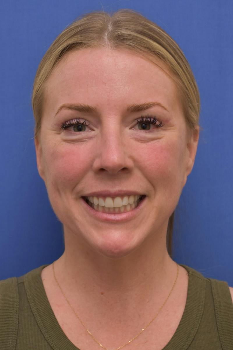 Blepharoplasty Before & After Gallery - Patient 360999 - Image 4