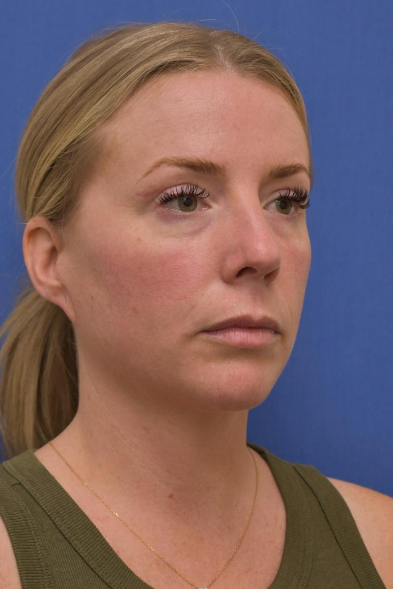 Blepharoplasty Before & After Gallery - Patient 360999 - Image 6