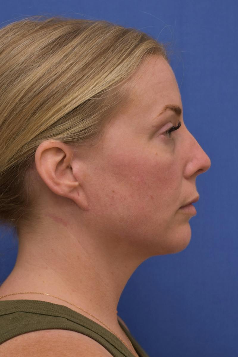 Blepharoplasty Before & After Gallery - Patient 360999 - Image 8