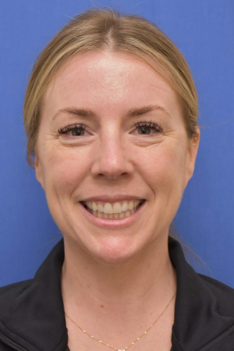 Blepharoplasty Before & After Gallery - Patient 360999 - Image 3