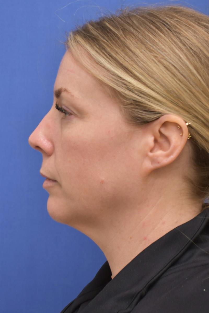 Blepharoplasty Before & After Gallery - Patient 360999 - Image 11
