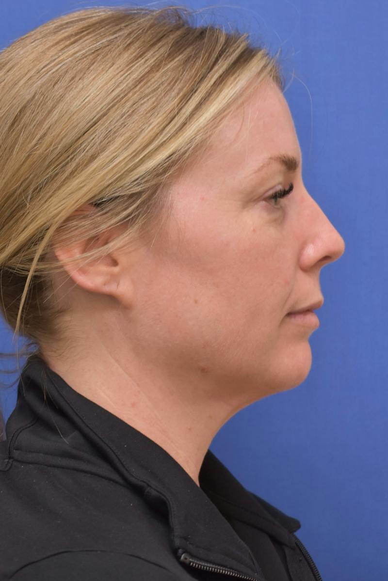 Blepharoplasty Before & After Gallery - Patient 360999 - Image 7