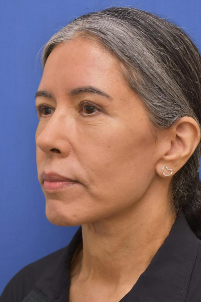 Necklift Before & After Gallery - Patient 297018 - Image 8