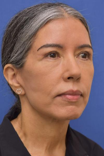 Facelift Before & After Gallery - Patient 171899 - Image 2