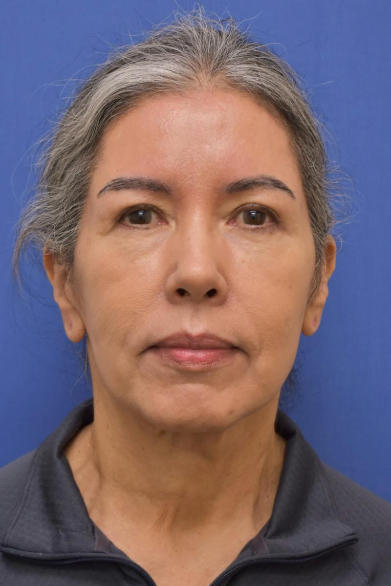 Necklift Before & After Gallery - Patient 297018 - Image 3