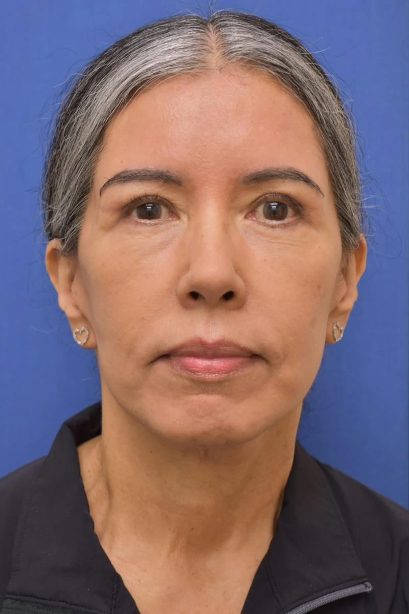 Necklift Before & After Gallery - Patient 297018 - Image 4