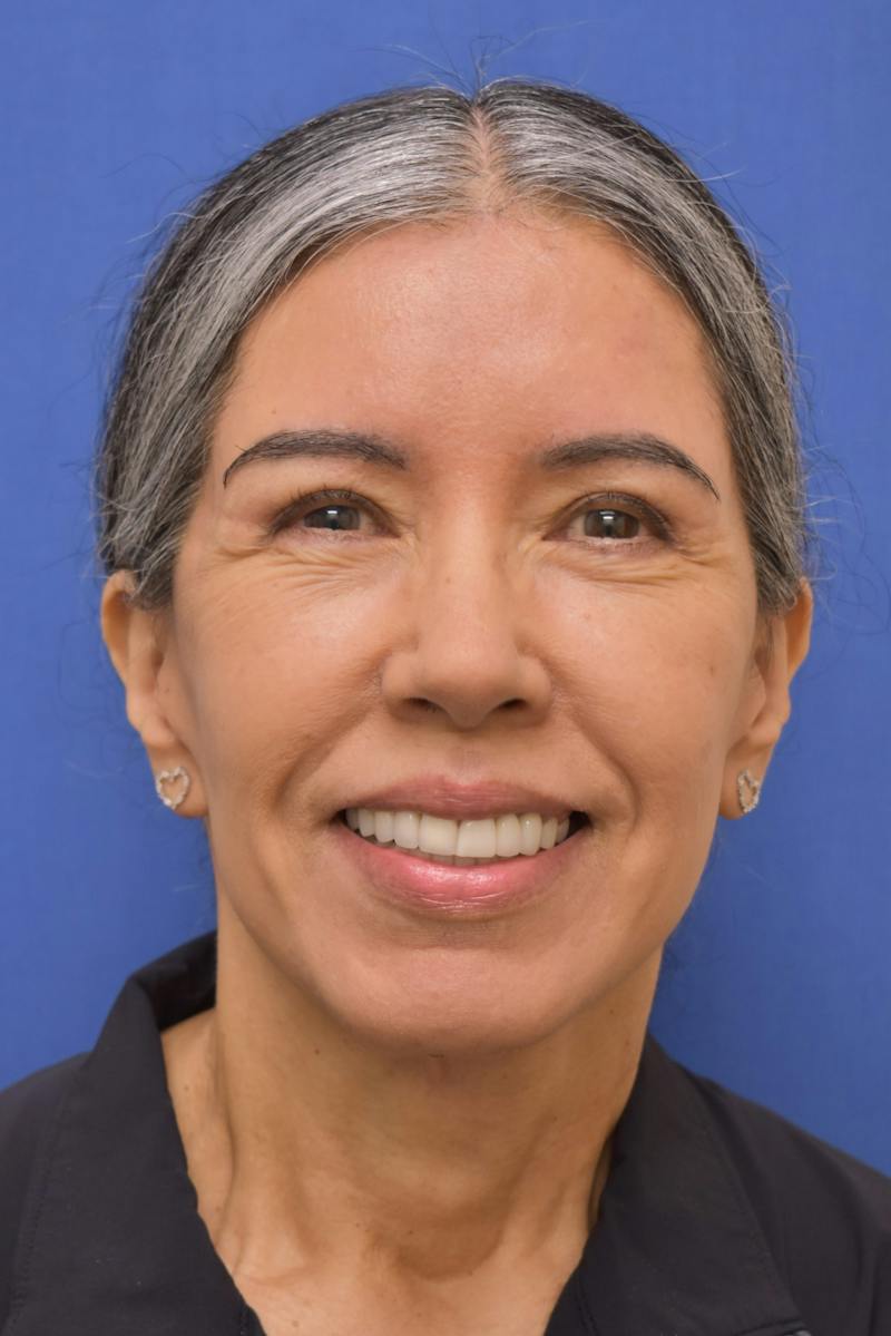 Necklift Before & After Gallery - Patient 297018 - Image 6