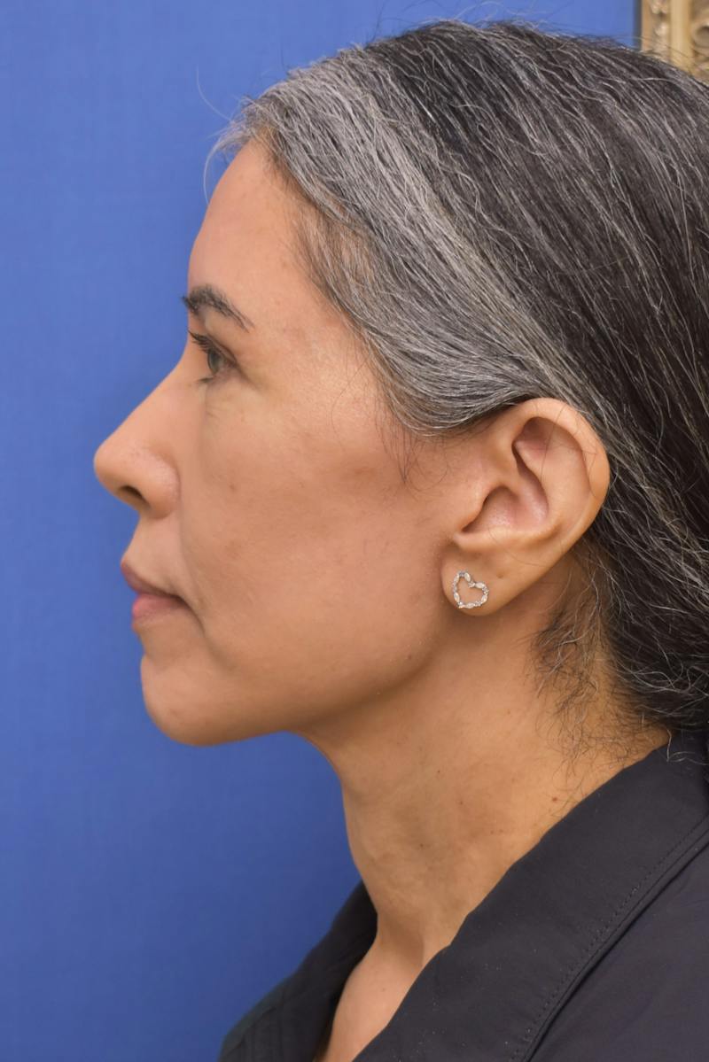 Necklift Before & After Gallery - Patient 297018 - Image 10