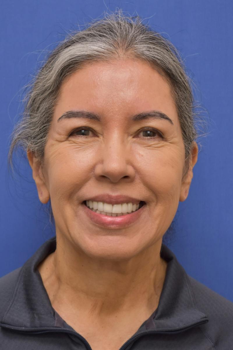 Necklift Before & After Gallery - Patient 297018 - Image 5