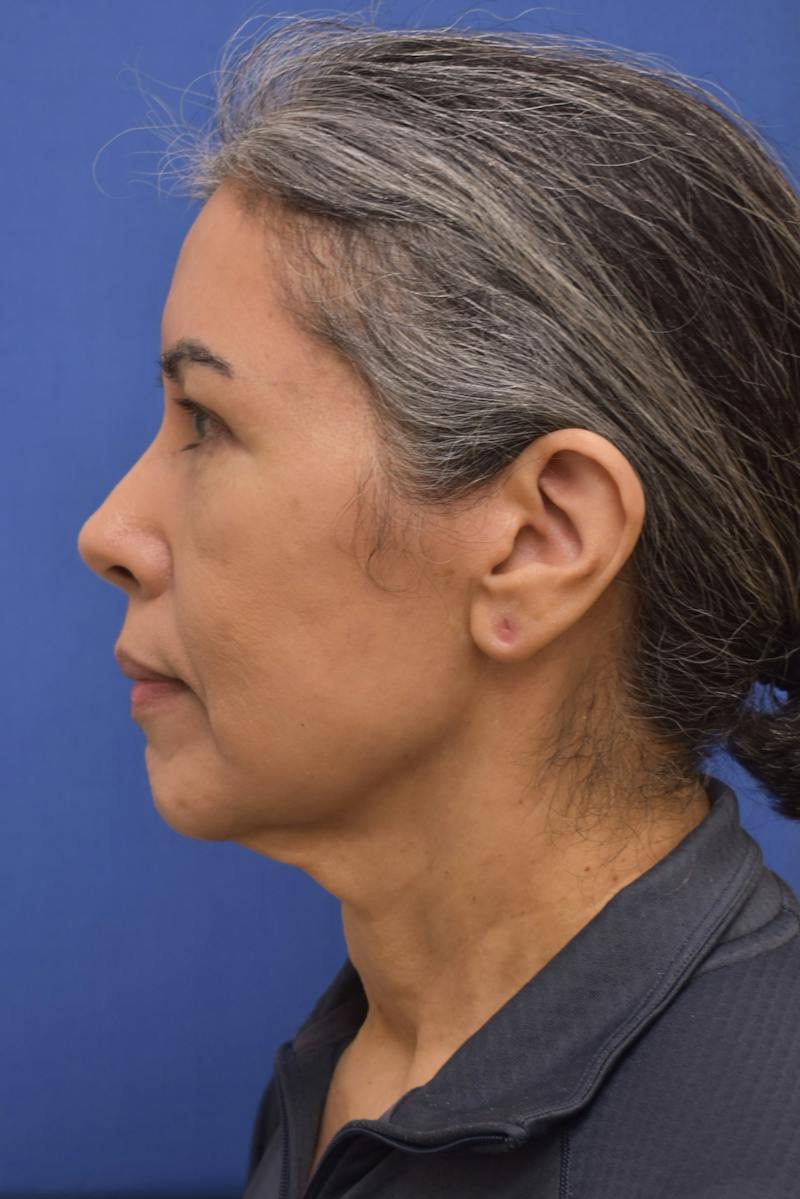 Necklift Before & After Gallery - Patient 297018 - Image 9