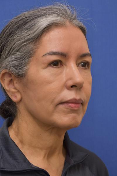 Facelift Before & After Gallery - Patient 171899 - Image 1
