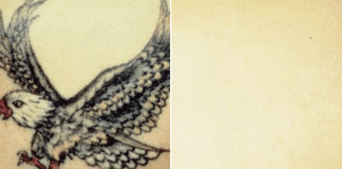 Tattoo Removal Before & After Gallery - Patient 176383 - Image 1