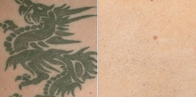 Tattoo Removal Before & After Gallery - Patient 368711 - Image 1