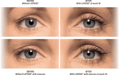 Latisse Before & After Gallery - Patient 328736 - Image 1