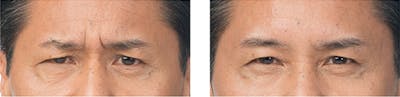 Cosmetic Injectables for Men Before & After Gallery - Patient 293101 - Image 1