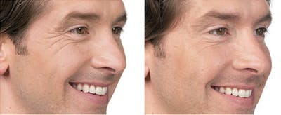 Cosmetic Injectables for Men Before & After Gallery - Patient 397725 - Image 1