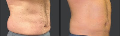 Coolscupting for Men Before & After Gallery - Patient 152467 - Image 1