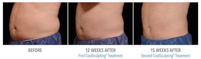 Coolscupting for Men Before & After Gallery - Patient 151796 - Image 1