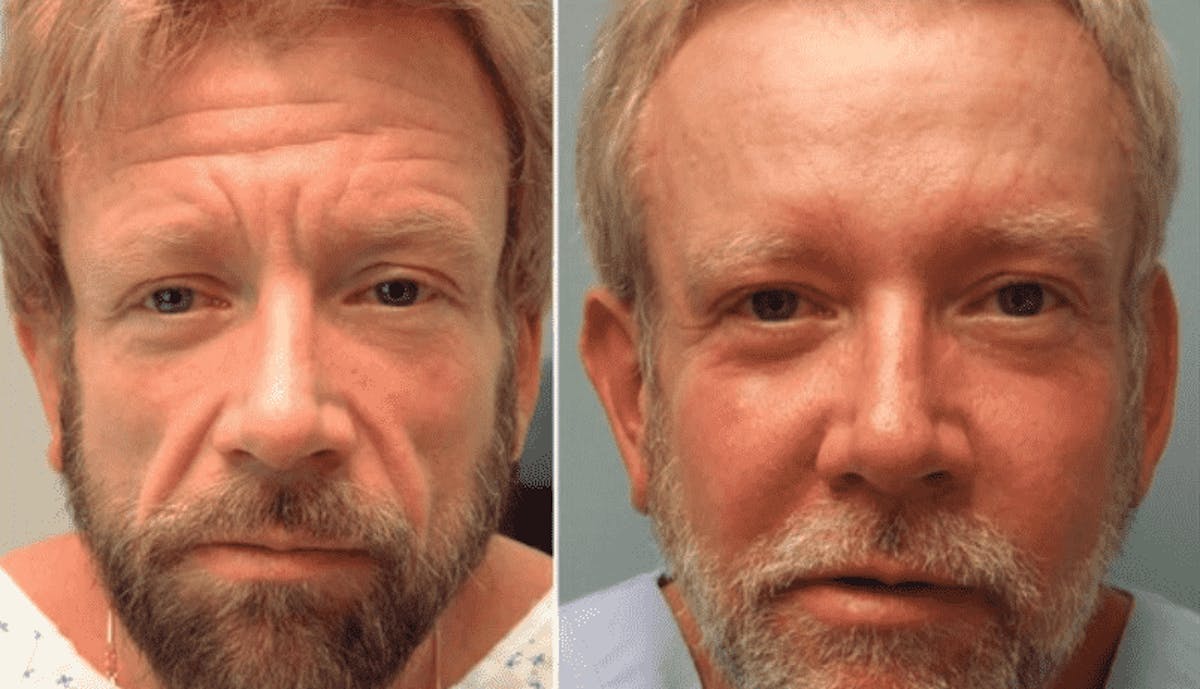Cosmetic Injectables for Men Before & After Gallery - Patient 155196 - Image 1