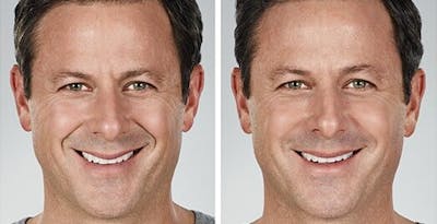 Cosmetic Injectables for Men Before & After Gallery - Patient 345399 - Image 1