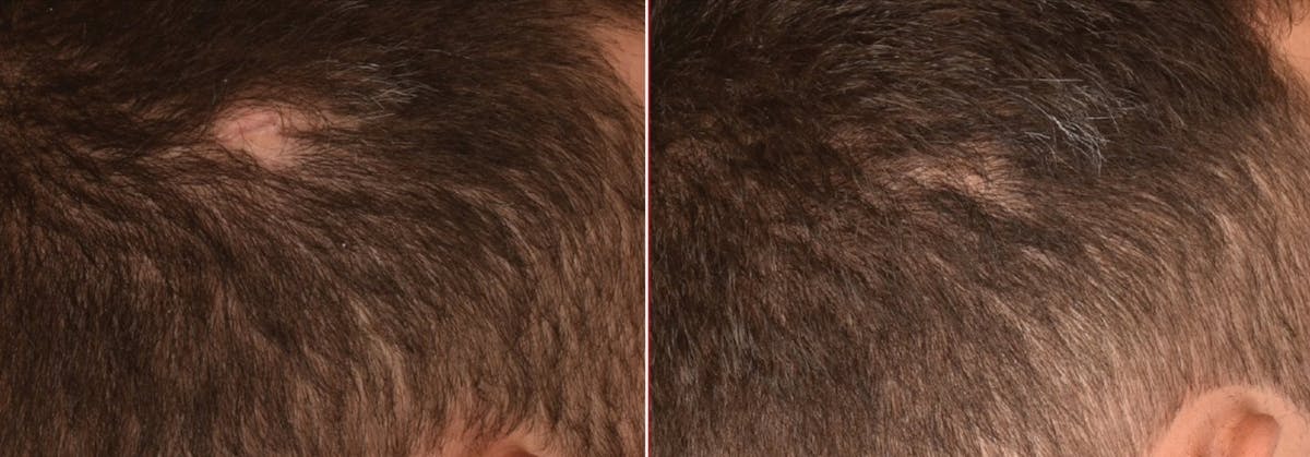 PRP & PRF for Men Before & After Gallery - Patient 401888 - Image 1