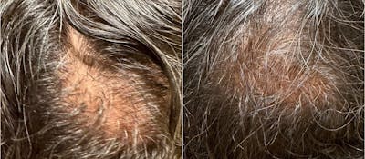PRP & PRF for Men Before & After Gallery - Patient 153724 - Image 1