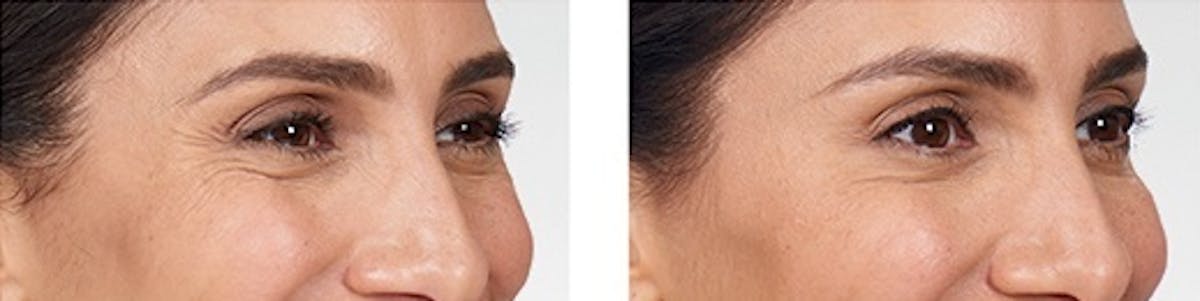 BOTOX Before & After Gallery - Patient 363587 - Image 1
