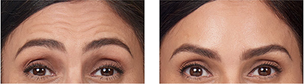 BOTOX Before & After Gallery - Patient 366420 - Image 1