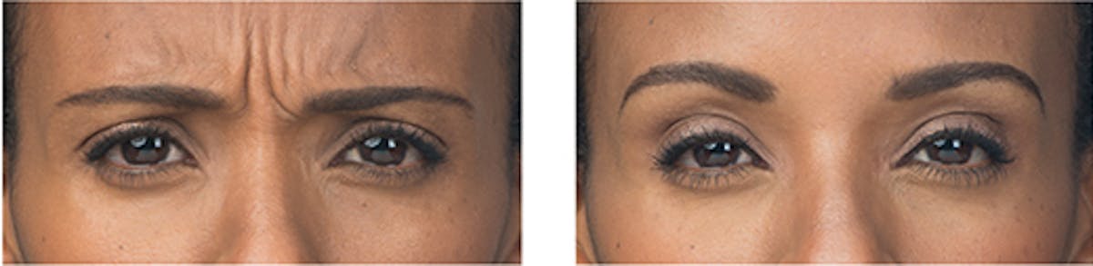 BOTOX Before & After Gallery - Patient 684963 - Image 1