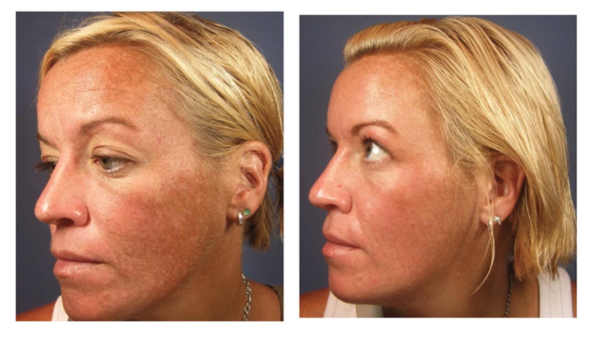 Chemical Peels Before & After Gallery - Patient 163743 - Image 1