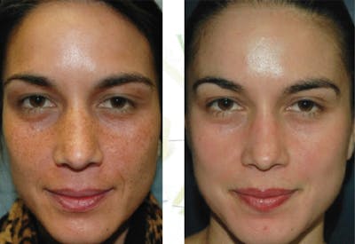 Chemical Peels Before & After Gallery - Patient 101052 - Image 1