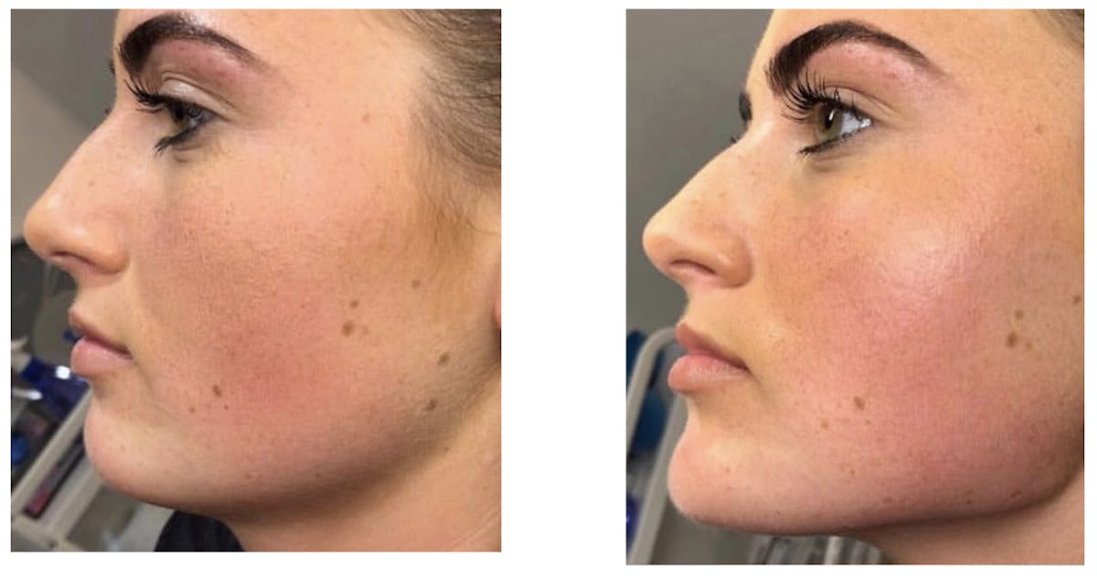 Gel Lift Before & After Gallery - Patient 307412 - Image 1