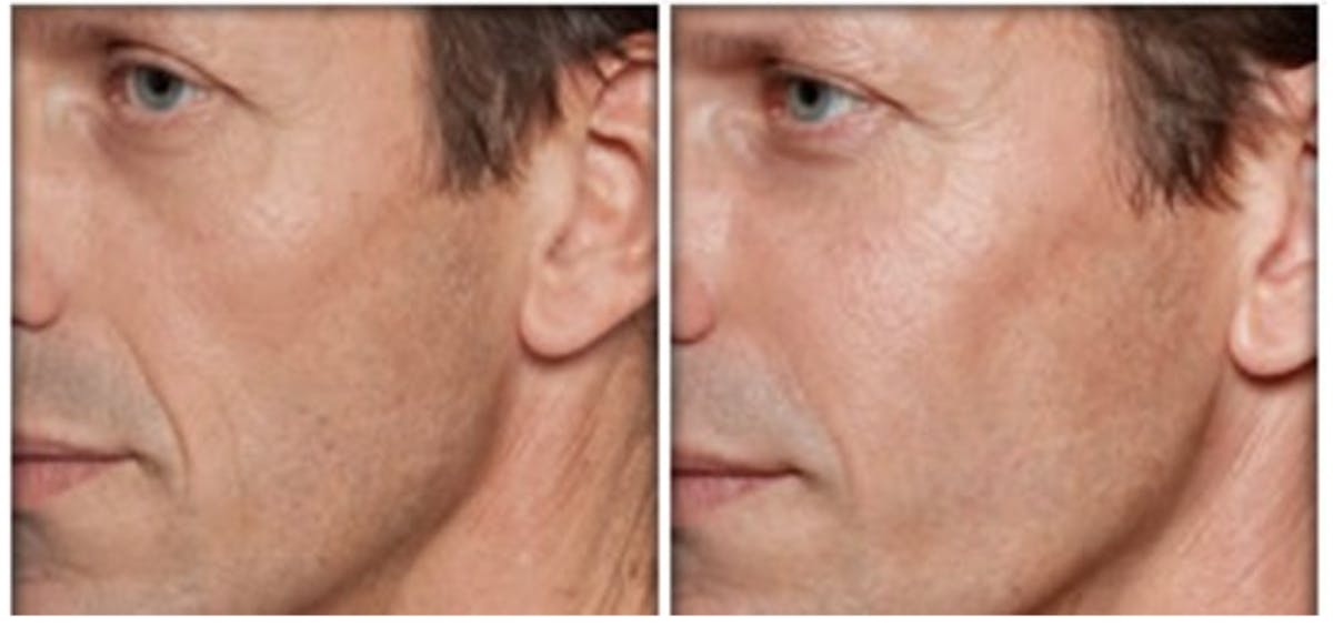 Gel Lift Before & After Gallery - Patient 353044 - Image 1