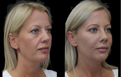 Gel Lift Before & After Gallery - Patient 404804 - Image 1