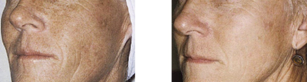 IPL Photorejuvenation Before & After Gallery - Patient 328892 - Image 1