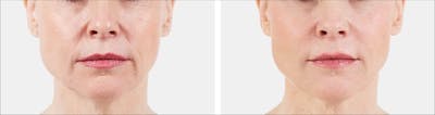 Juvederm Before & After Gallery - Patient 287578 - Image 1