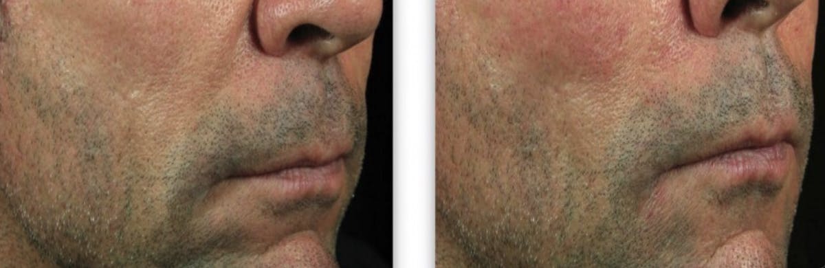 Juvederm Before & After Gallery - Patient 987663 - Image 1