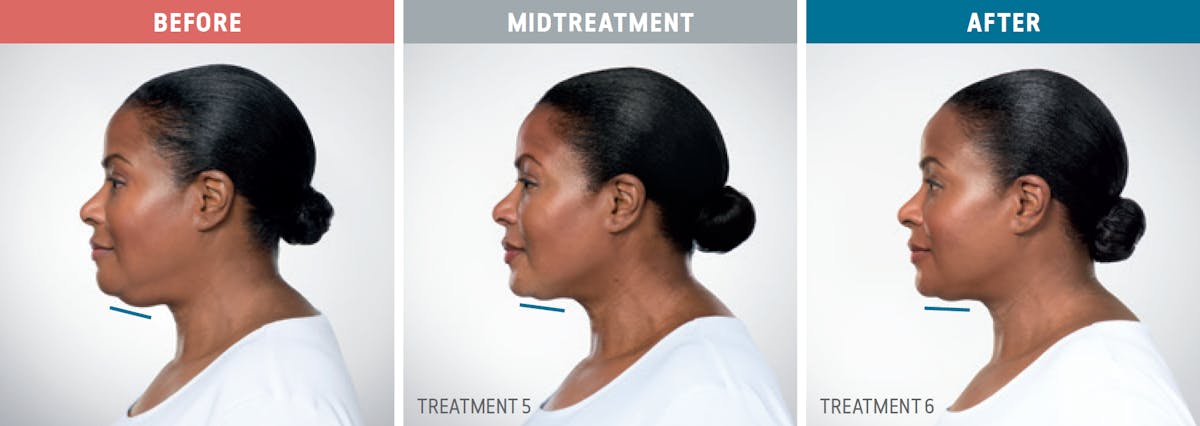 Kybella Before & After Gallery - Patient 283070 - Image 1
