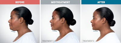 Kybella Before & After Gallery - Patient 283070 - Image 1