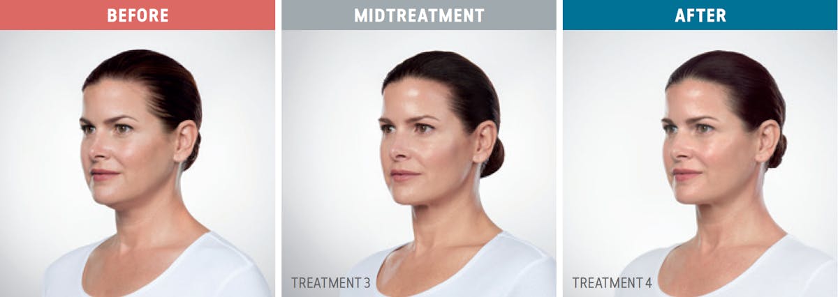 Kybella Before & After Gallery - Patient 432925 - Image 1