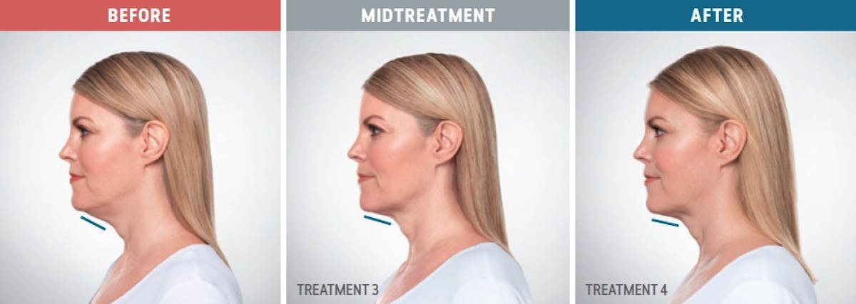 Kybella Before & After Gallery - Patient 653270 - Image 1
