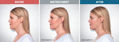 Kybella Before & After Gallery - Patient 653270 - Image 1