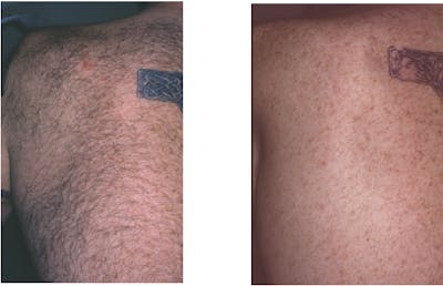 Body Laser Hair Removal Before & After Gallery - Patient 334129 - Image 1