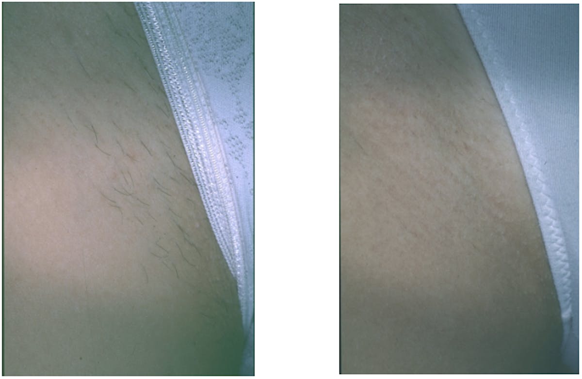 Body Laser Hair Removal Before & After Gallery - Patient 135090 - Image 1