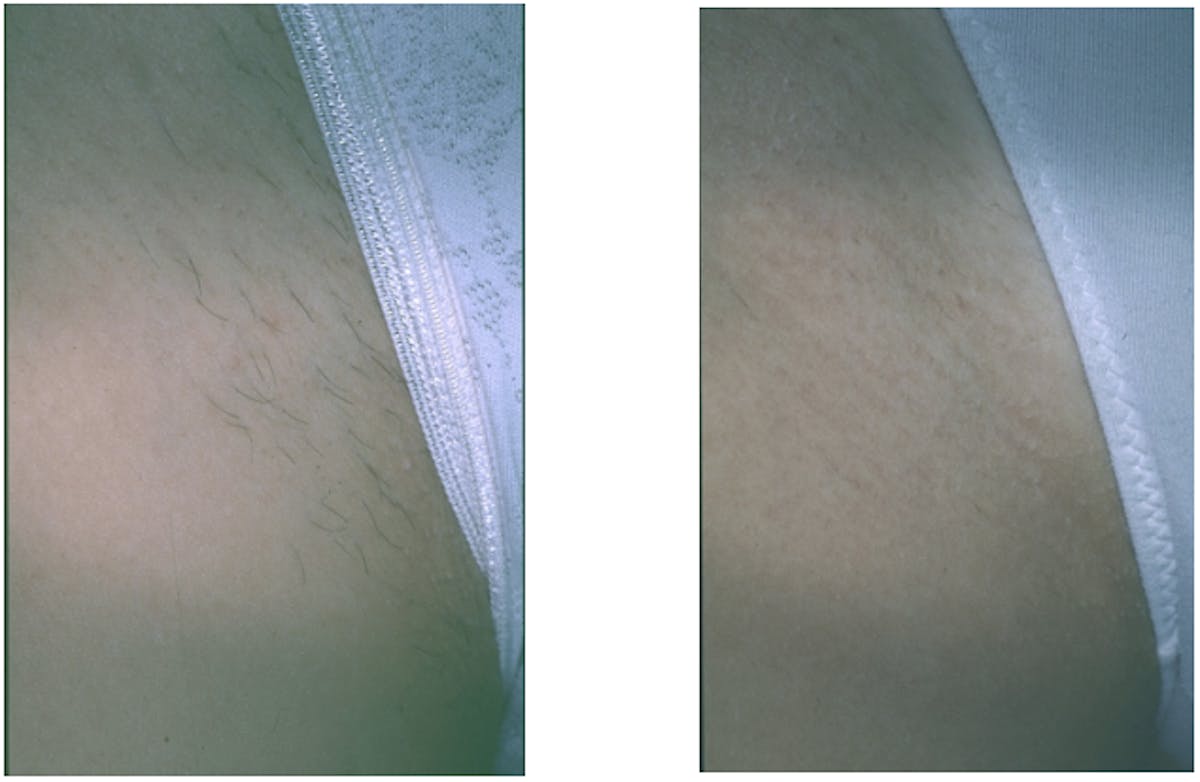 Laser Hair Removal