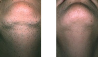 Face Laser Hair Removal Before & After Gallery - Patient 810993 - Image 1