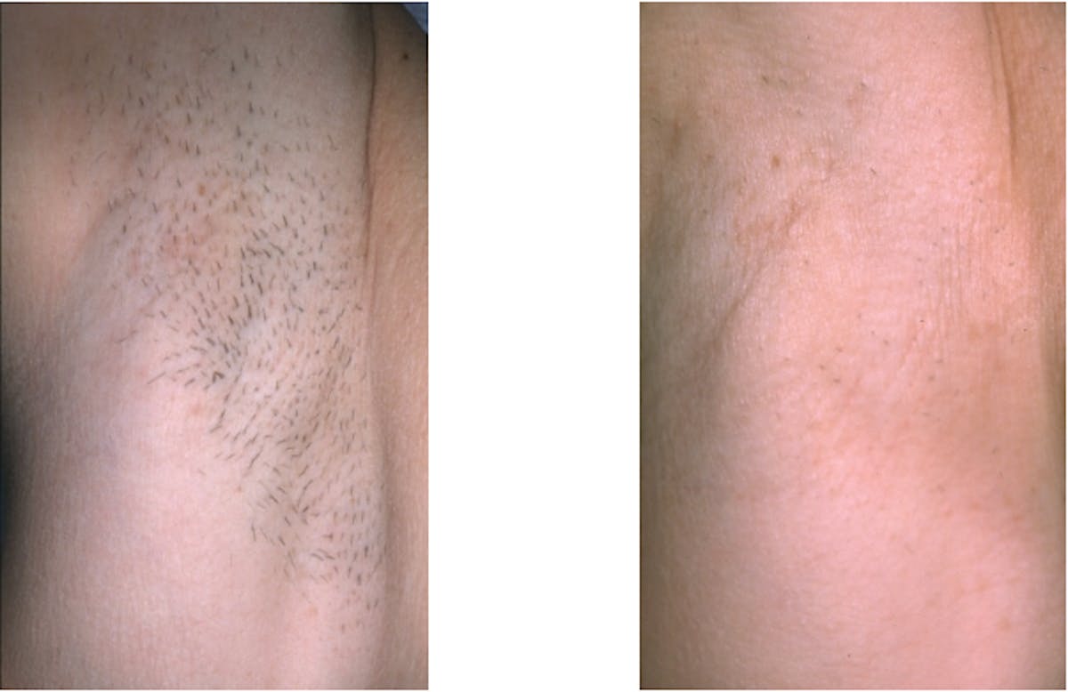 Body Laser Hair Removal Before & After Gallery - Patient 359349 - Image 1