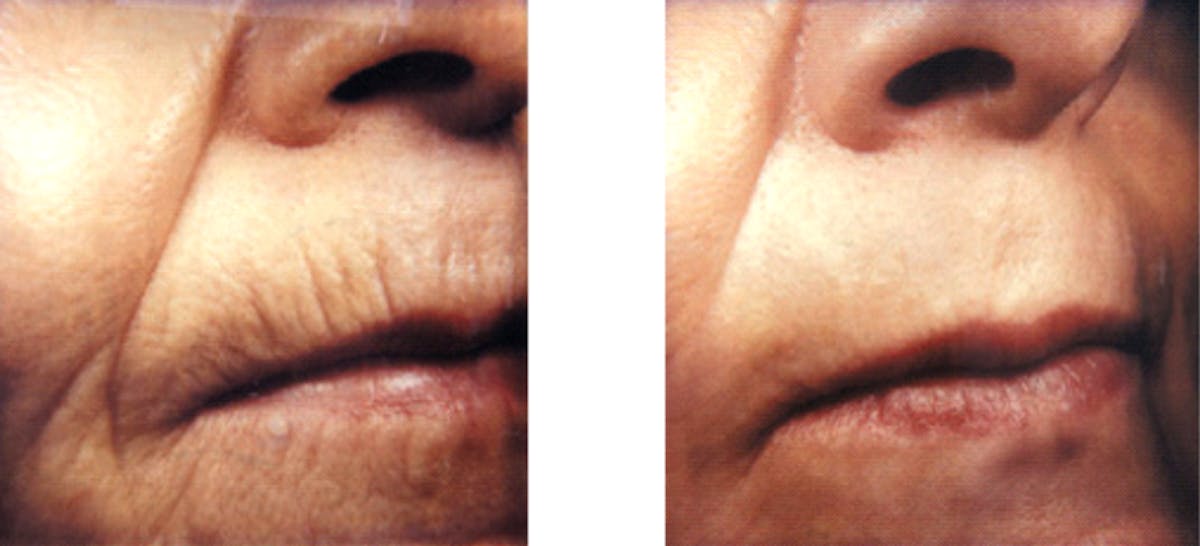 Laser Resurfacing Before & After Gallery - Patient 331198 - Image 1