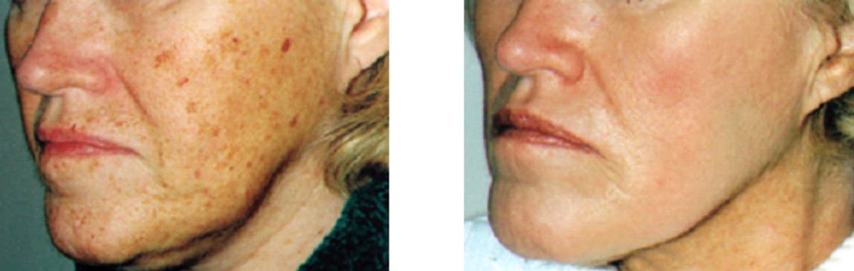 Laser Resurfacing Before & After Gallery - Patient 317926 - Image 1